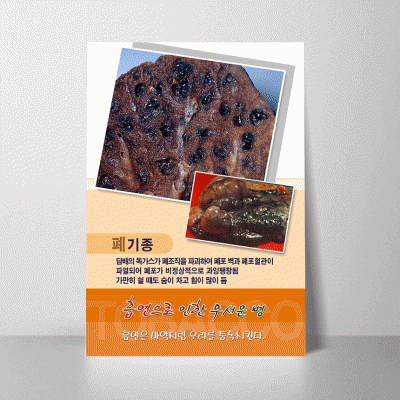 H68.흡연-폐기종